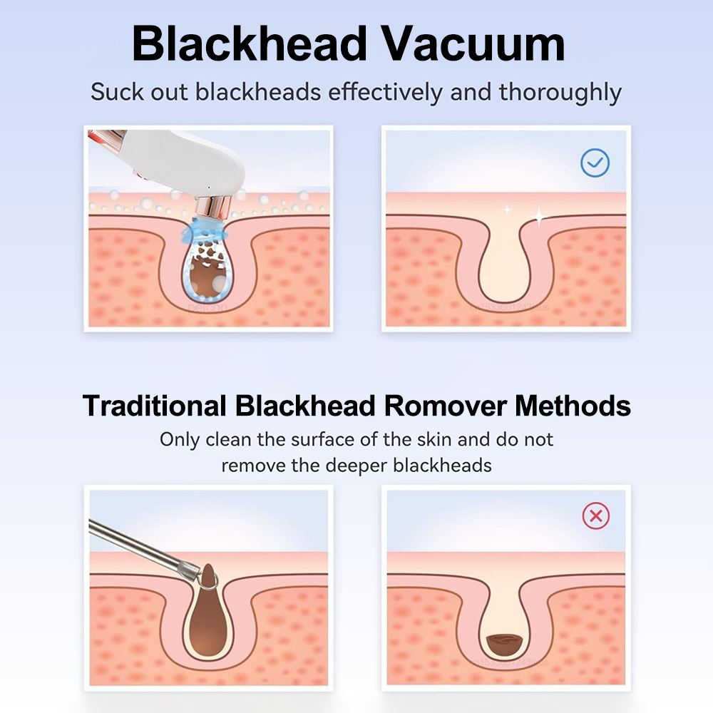 電気にきびリムーバー真空顔毛穴クリーナー充電式ディープダート - Blackhead Remover Vacuum Suction のレビューと価格