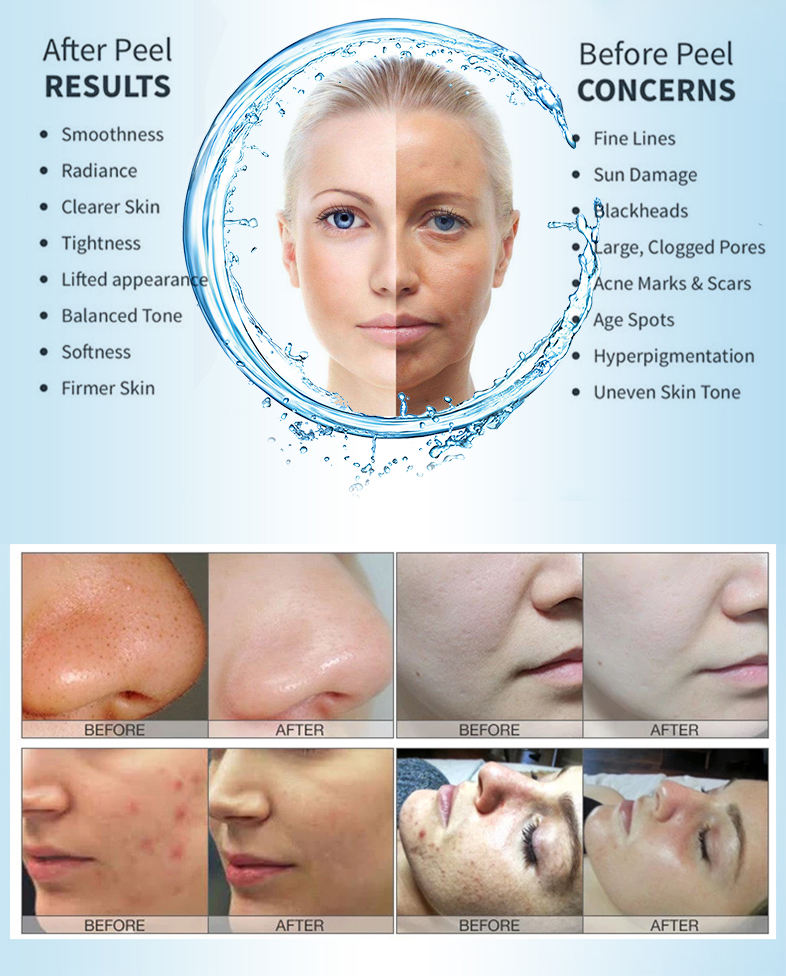 ハイドラ4in1アクアピーリングスキンハイドロダーマブレーシ - Hydra Dermabrasion Aqua Peel Machine のレビューと価格