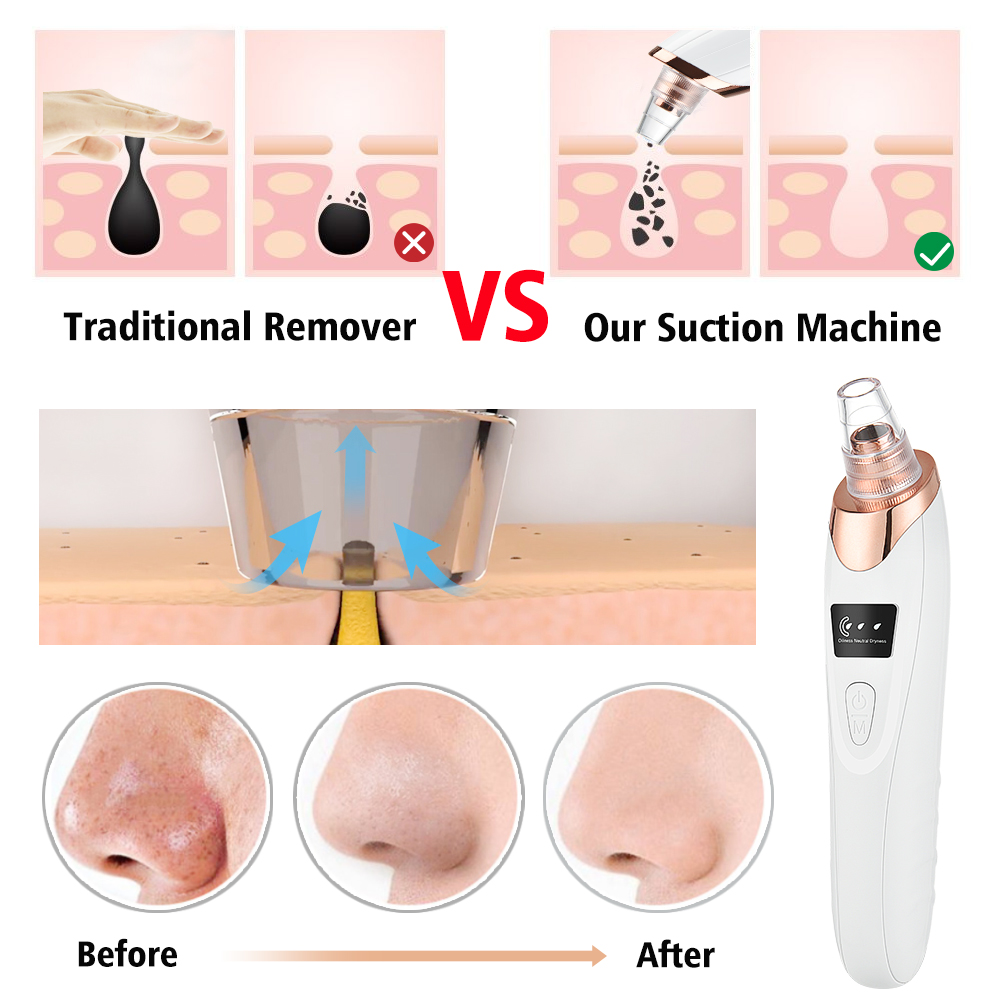 にきびやにきび用の掃除機,毛穴をきれいにするフェイシャルクレ - Blackhead Remover Vacuum Suction のレビューと価格